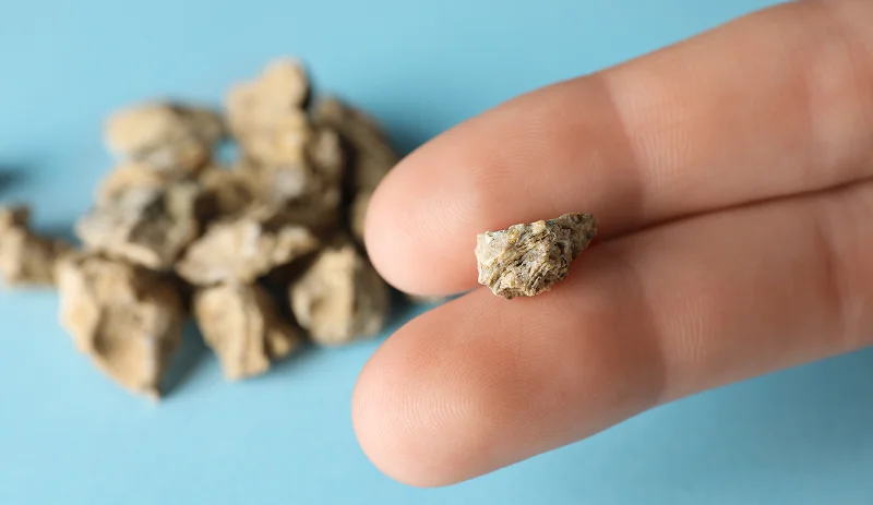 Close-up of a small extracted kidney stone held between fingers for size comparison