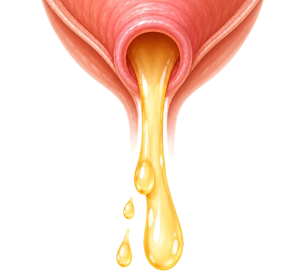 Diagram demonstrating the final stage of kidney stone excretion during urination through the urinary tract.