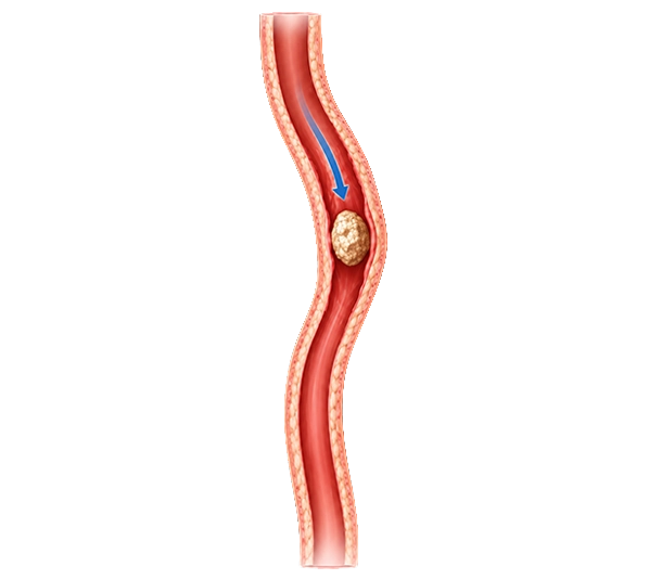 Diagram illustrating a kidney stone traveling down and causing blockage in the narrow ureter tube.